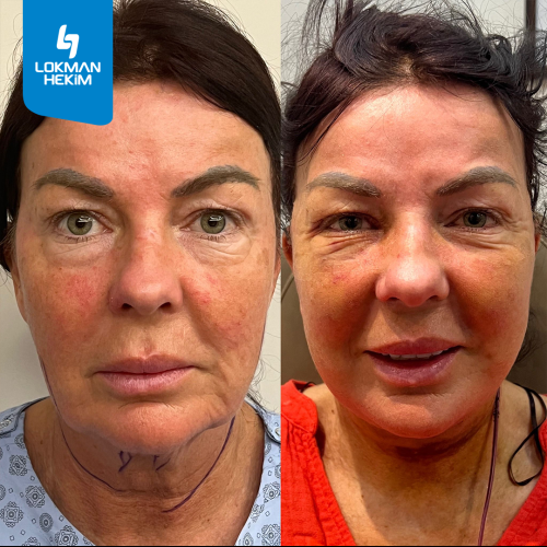 Thread lift Before / After photo